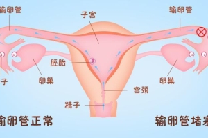 上海禾新医院生殖与不孕专科：输卵管堵塞5原因﹣你是第几种-